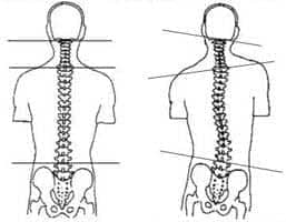 misalignment-in-cervical-vertebra-cure-by-chiropractic-care